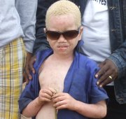Blessings for Albino children in Uganda
